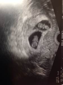 twin_ultrasound